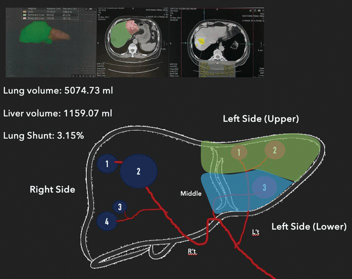 Figure13Dvolumetricimagingreconstructiontechnologycalculatesthevolumesoftheliverandtumorsallowingphysicianstoselectthemostappropriatetreatmentdose